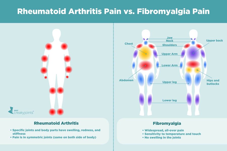 A Patient s Guide To Understanding Rheumatoid Arthritis Pain