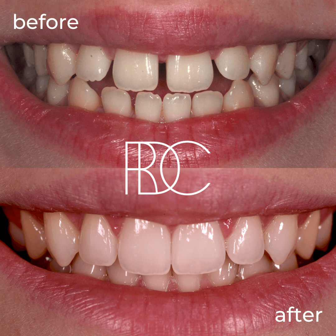 Invisalign Offer Ropergate Dental Care Orthodontist Near me