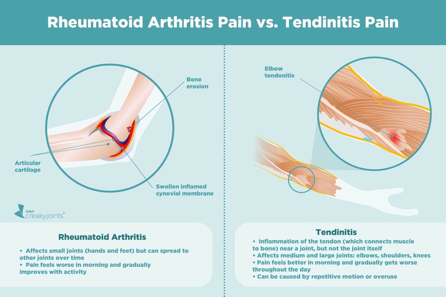 A Patient’s Guide to Understanding Rheumatoid Arthritis Pain