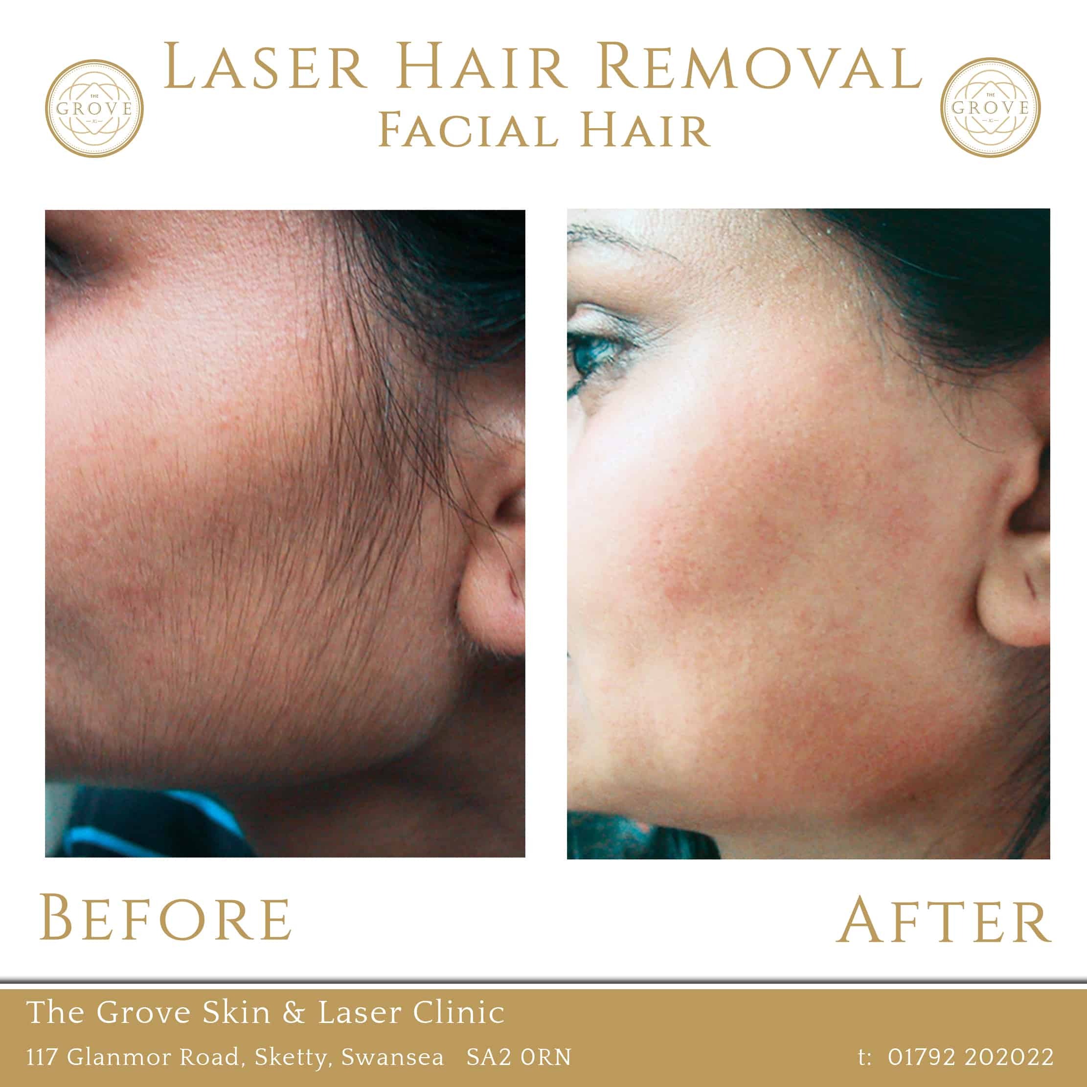 The Grove Skin & Laser Clinic - Laser Hair Removal Face