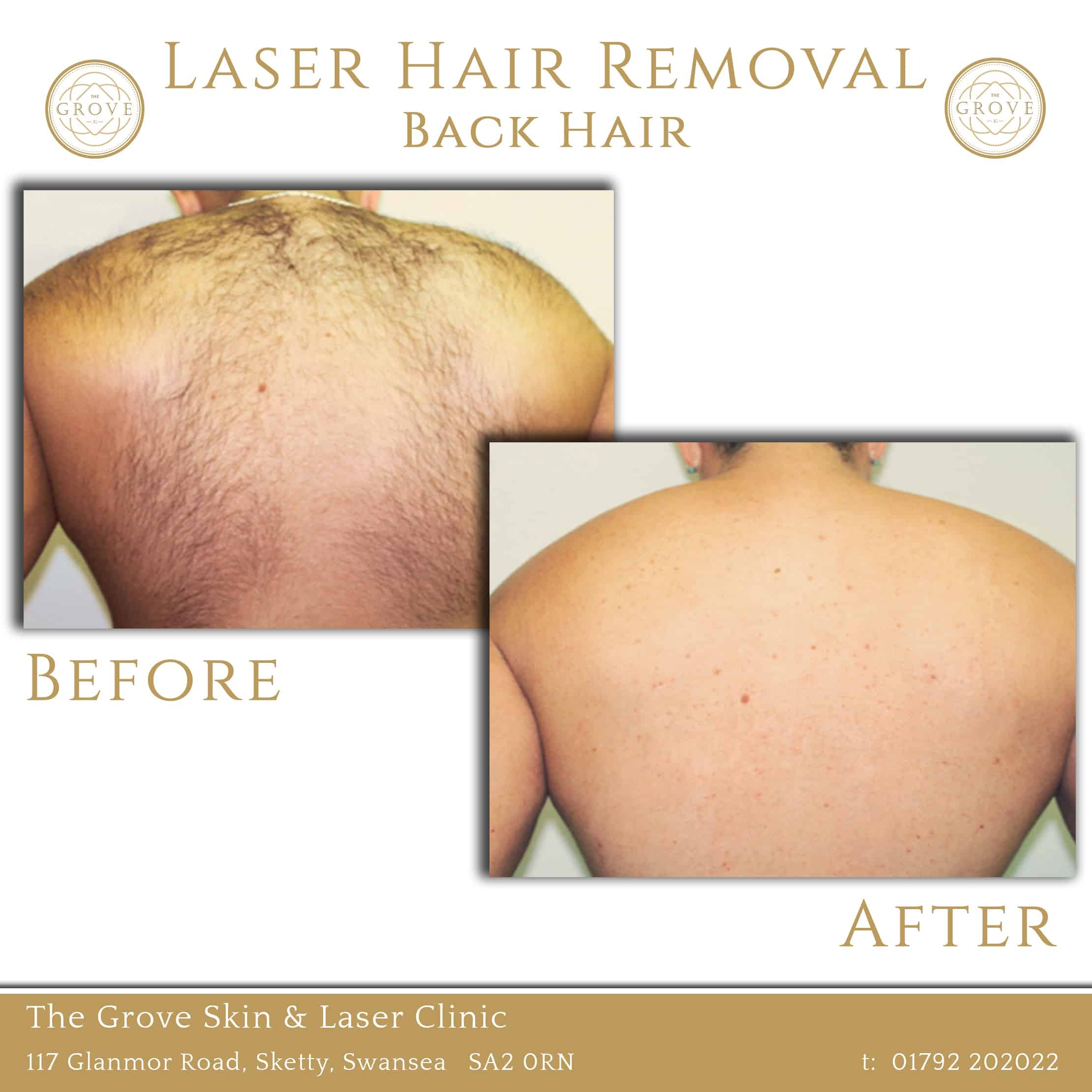 The Grove Skin Laser Clinic Laser hair Removal