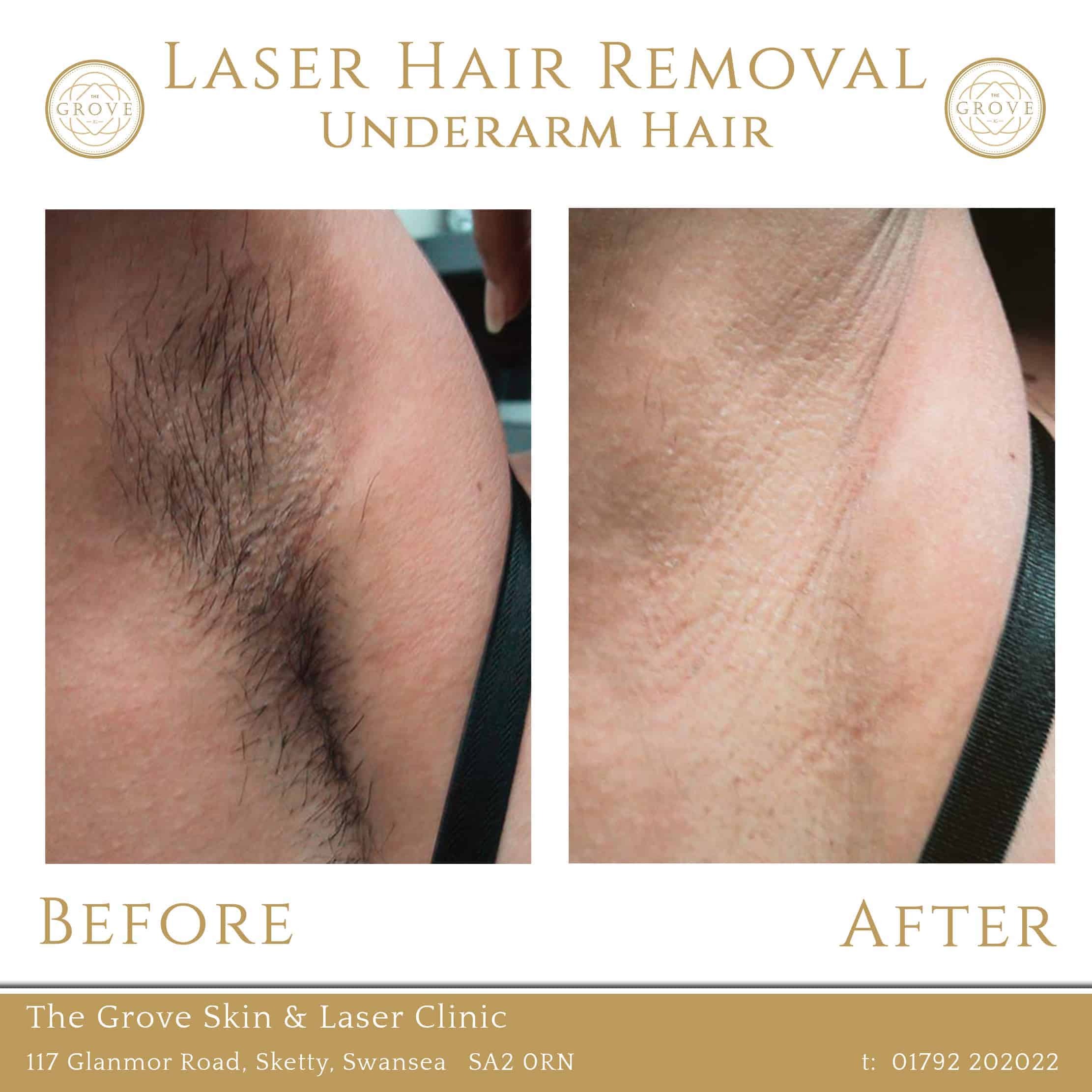 The Grove Skin Laser Clinic Laser hair Removal