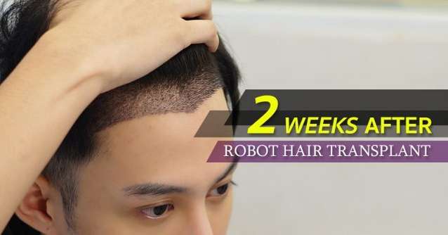 Robotic Hair Transplant Robotic Hair Transplant