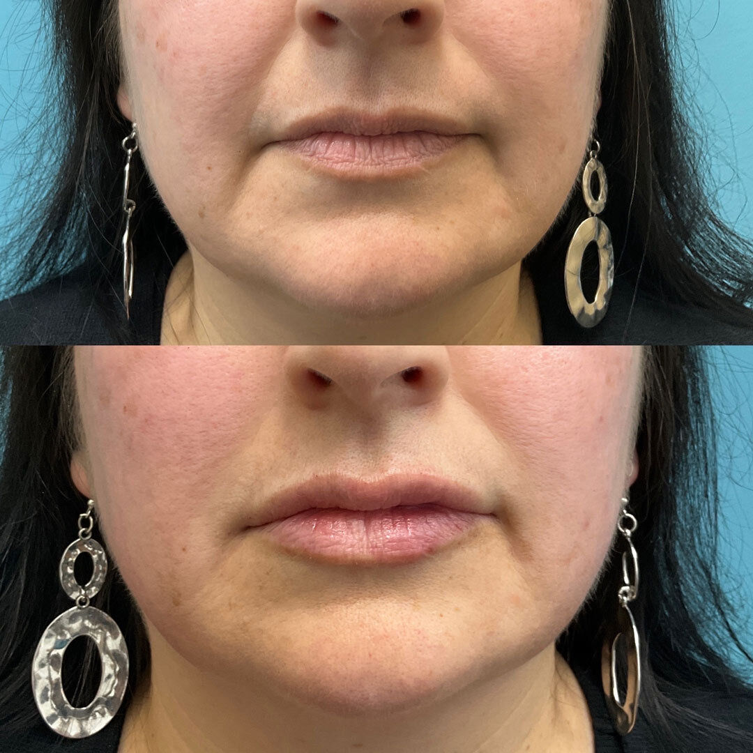 thermage for skin tightening before and after