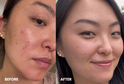 Side-by-side comparison of a woman's face before and after skincare treatment.