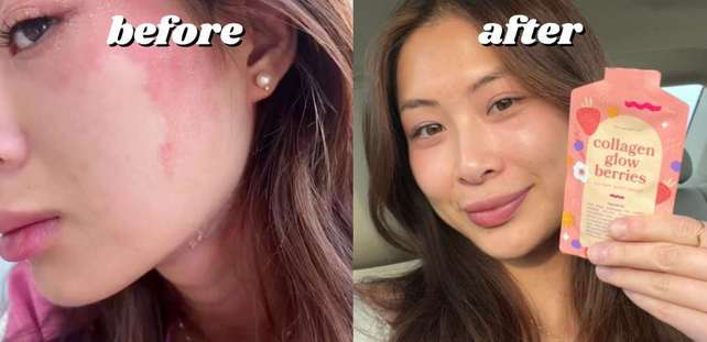 Side-by-side comparison of a woman's face before and after using a skincare product.