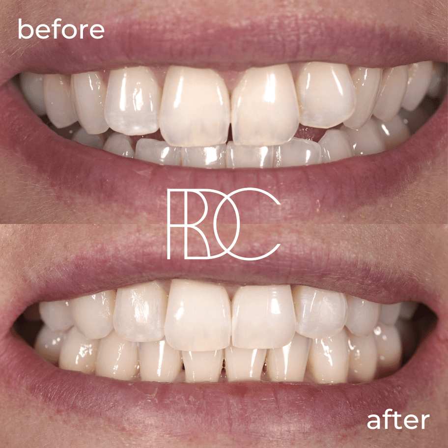 Invisalign Offer Ropergate Dental Care Orthodontist Near me