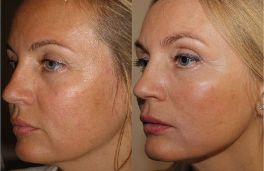 Before and after thread lift 2 Before and after thread lift 2
