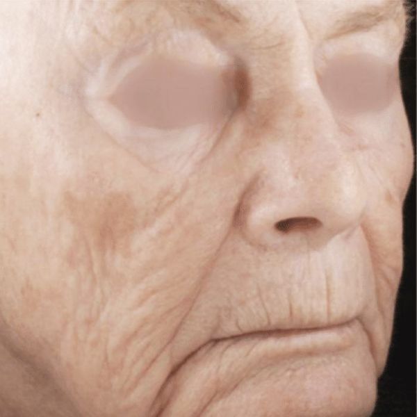 Laser Scar Removal at Juvea