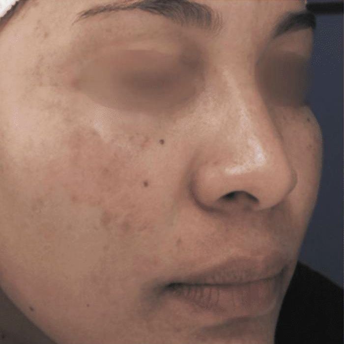 Laser Scar Removal at Juvea