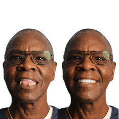 Dale Brukley Dental Implants Before and After Transformation