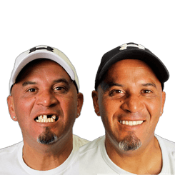 Julio Hernandez Dental Implants Before and After Transformation