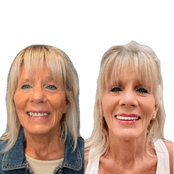 Maureen Carey Dental Implants Before and After Transformation