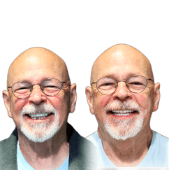 Randall Dental Implants Before and After Transformation