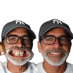 Craig Cofrancesco Dental Implants Before and After Transformation