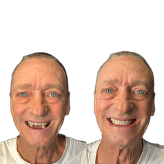 Brian Bond Dental Implants Before and After Transformation