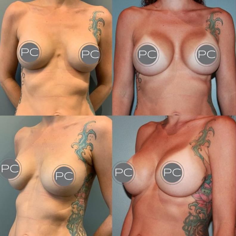 Before And After Breast Aug Photos

