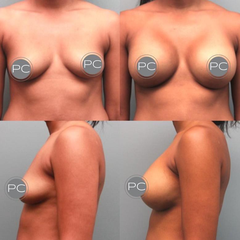 Before And After Breast Photos
