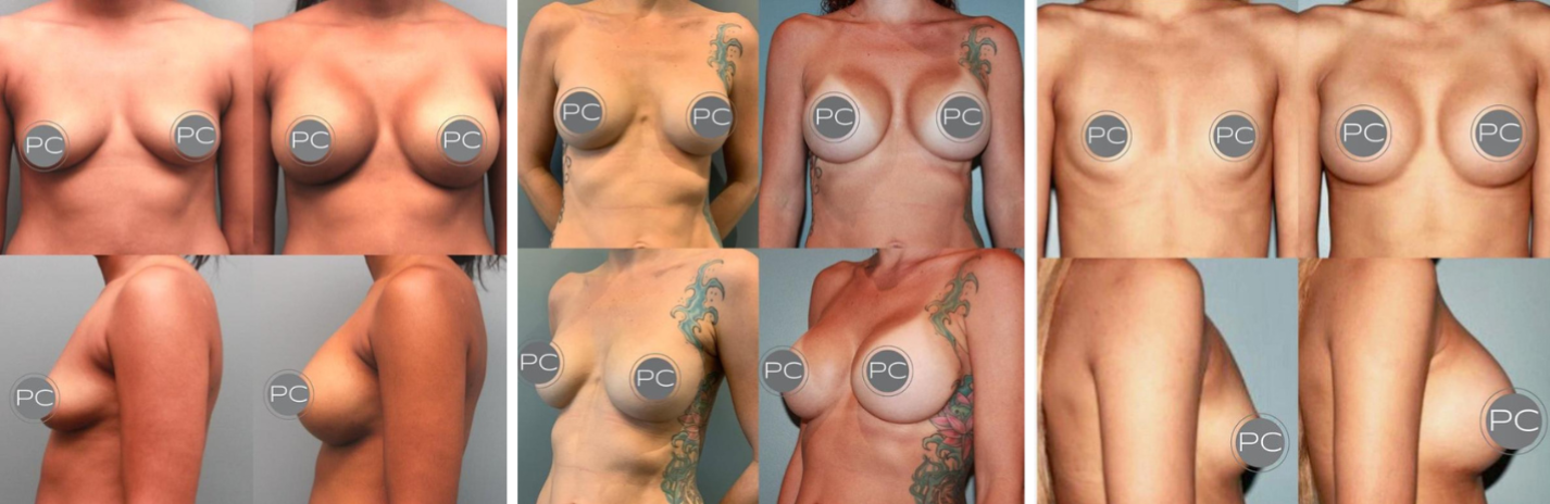 Before And After Photos Breast Augmentation

