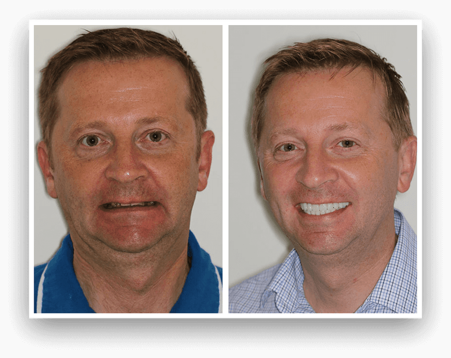 Get the smile you deserve with the best in dental implants ...
