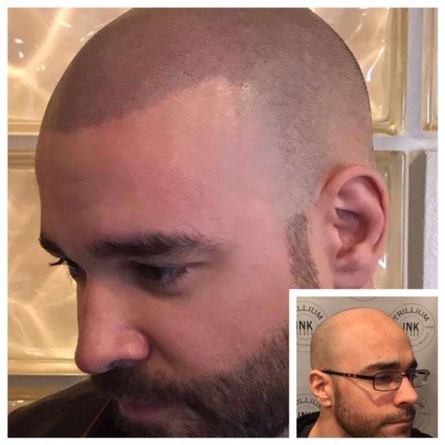 Scalp micropigmentation client at Trillium Ink