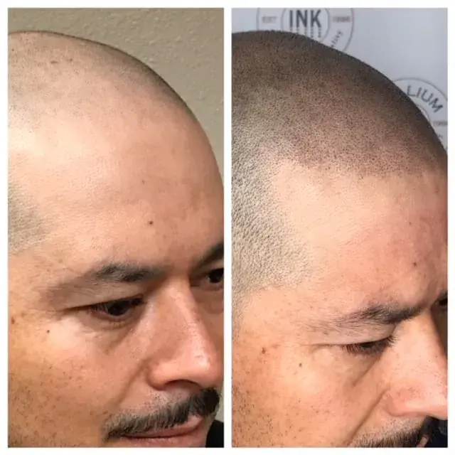 Before and after scalp micropigmentation on a shaved head, front hairline