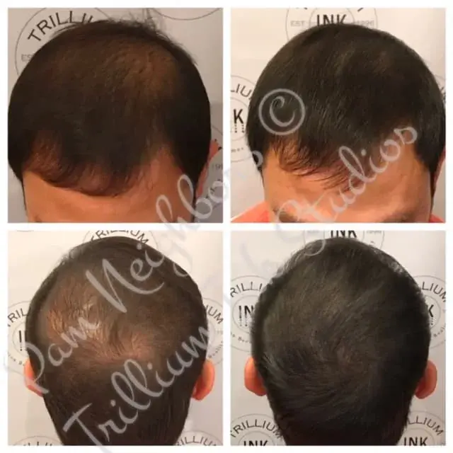 Before and after SMP adding density to thinning hair, front and crown