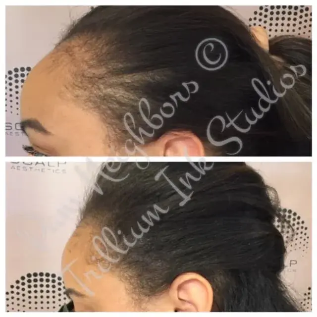 Before and after SMP along a woman's hairline