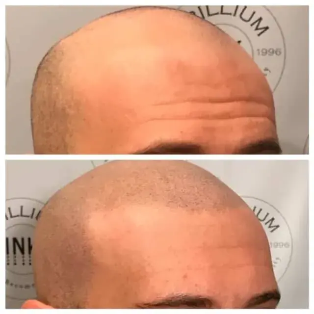 Before and after SMP hairline restoration