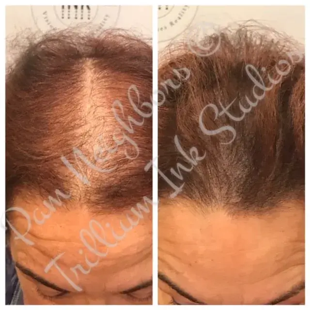 Before and after SMP along a woman's part line