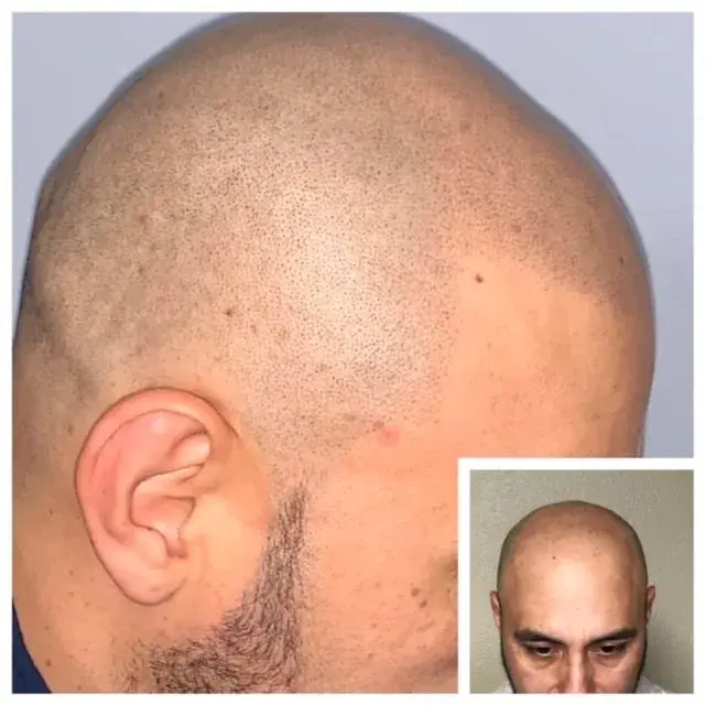 Scalp micropigmentation result on a fully shaved head