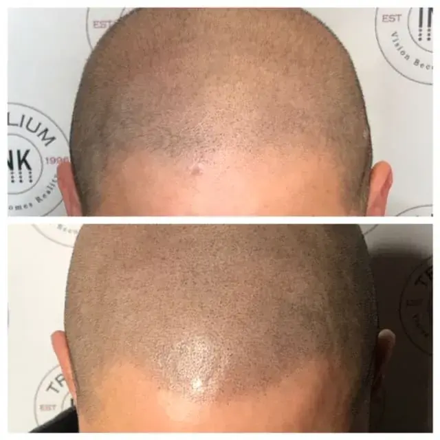 Before and after SMP on a shaved head, top view