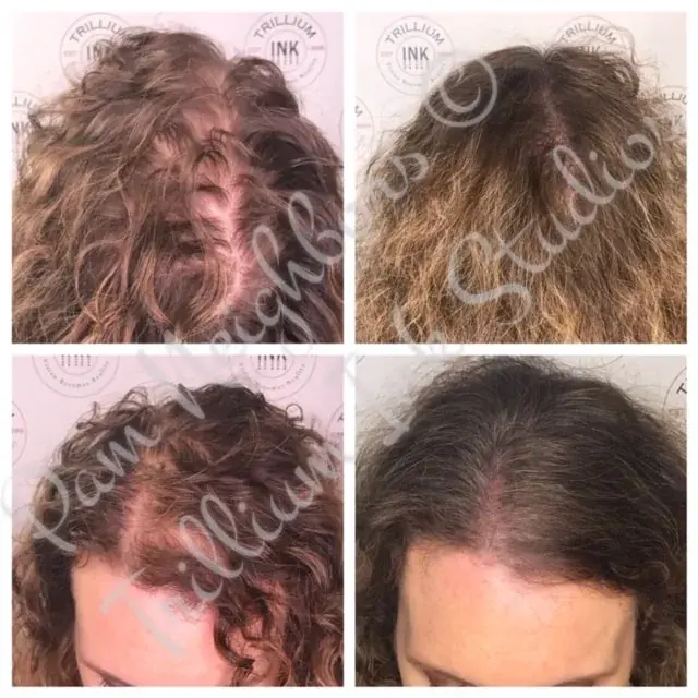 Before and after SMP for a woman's thinning part