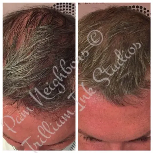 Before and after SMP for thinning grey hair