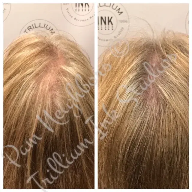 Before and after SMP for a woman's thinning crown