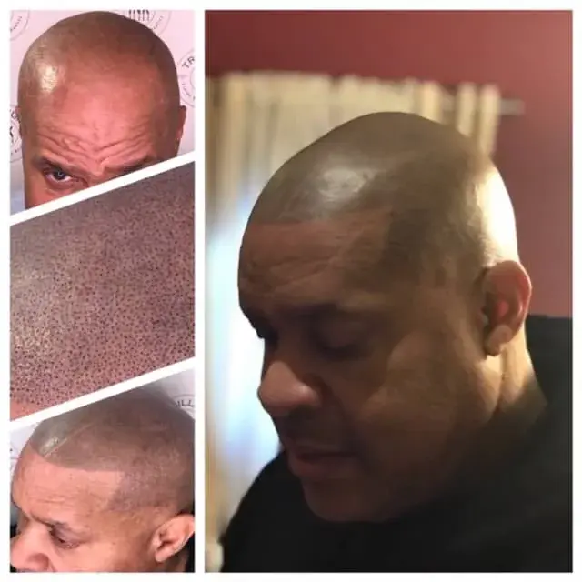 SMP in progress and the finished hairline