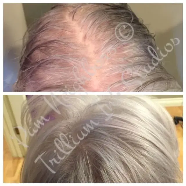 Before and after SMP for a woman's thinning grey hair