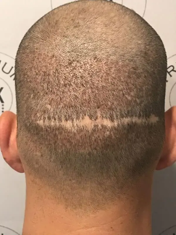 Scalp scar on the back of the head, a common SMP camouflage case