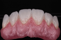 Coroa Zircônia Multilayer