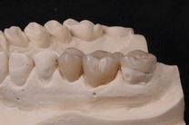 Coroa sobre Dente
