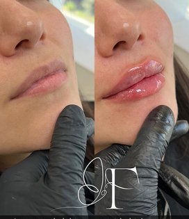 Dra. Francisca Fuentes Clínica Estética Ácido Hialurónico