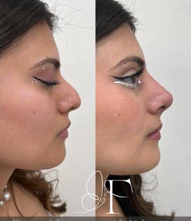Dra. Francisca Fuentes Clínica Estética Lipopapada Enzimática