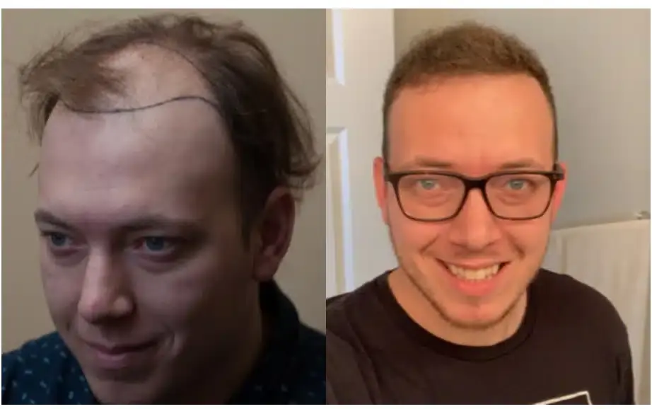 SmartGraft before and after