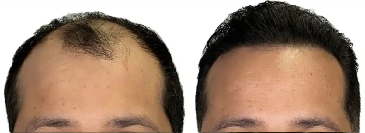 Hair transplant before and after