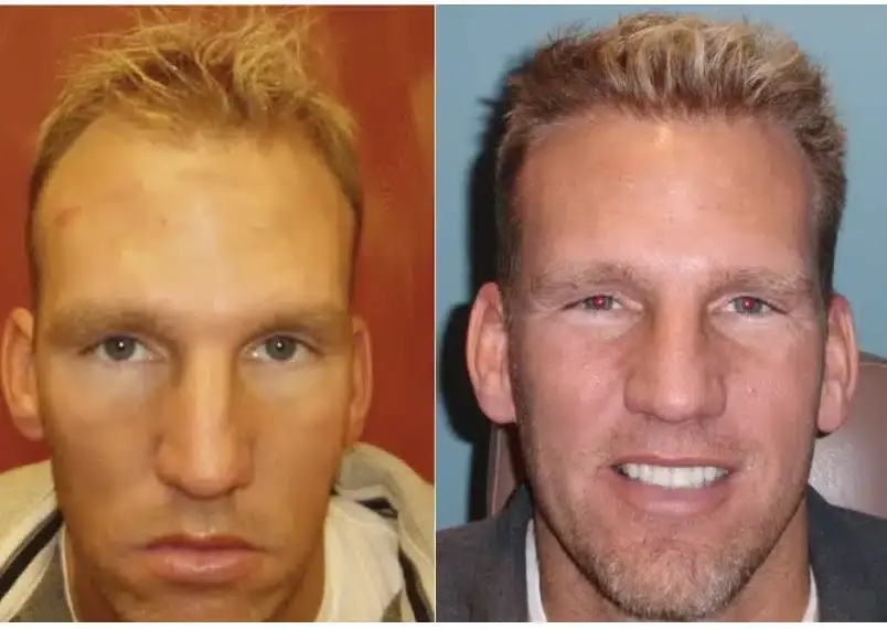 SmartGraft before and after