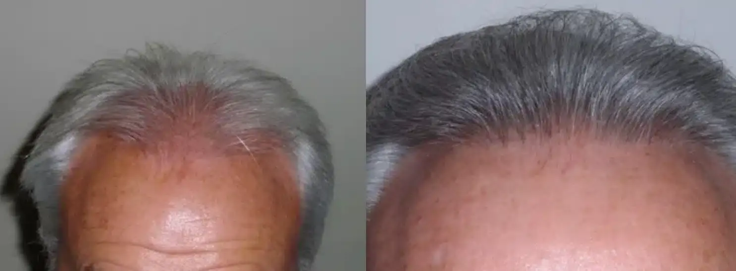 SmartGraft before and after