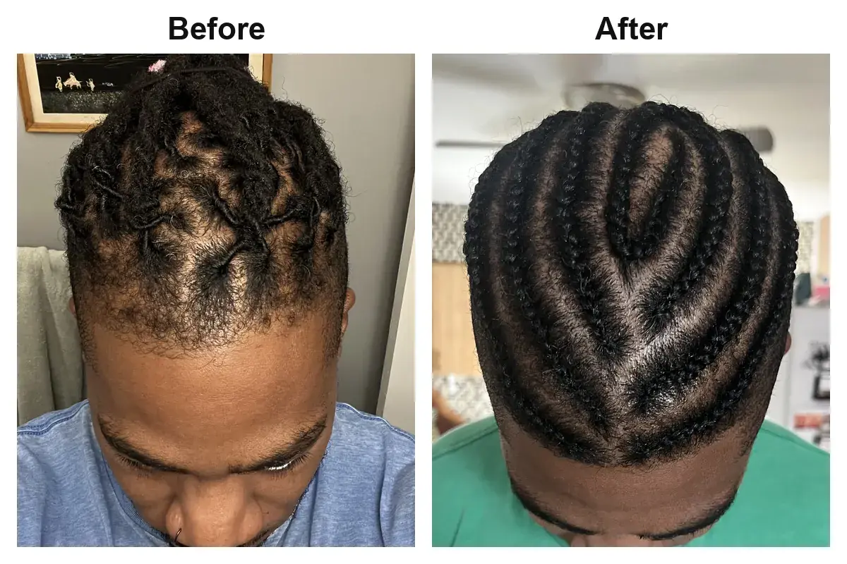 Hair transplant before and after