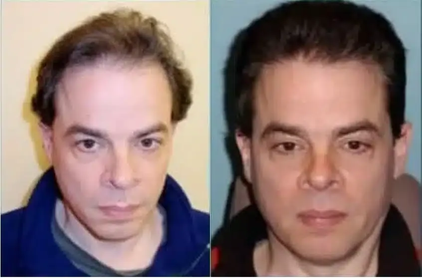SmartGraft before and after