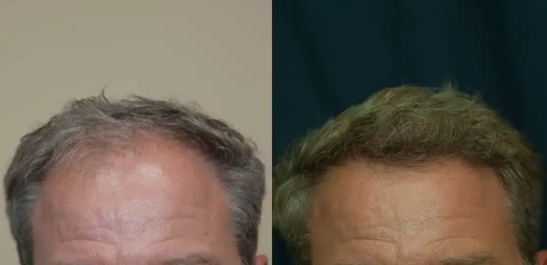 SmartGraft before and after