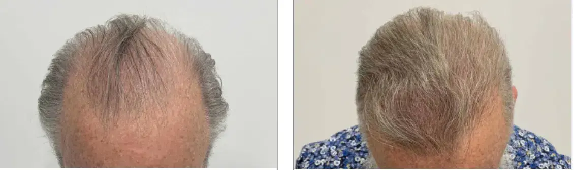 FUE ARTAS before and after